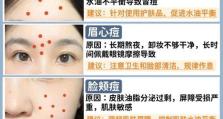 消除额头痘痘，重拾清爽肌肤的秘密（有效去除额头痘痘，告别尴尬问题）